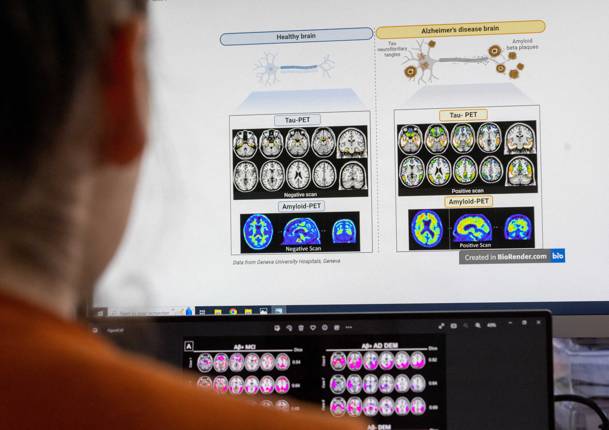 Εργαλείο τεχνητής νοημοσύνης αποκωδικοποιεί το γονιδίωμα του καρκίνου του εγκεφάλου