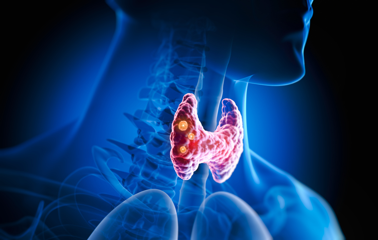 Thyroid gland with nodules inside human body - 3D illustration