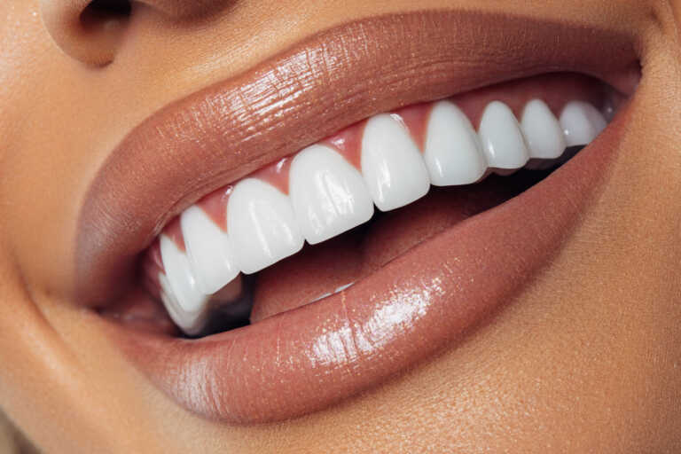 Λεύκανση δοντιών: Ο ανώδυνος τρόπος να «αλλάξετε» το χαμόγελό σας