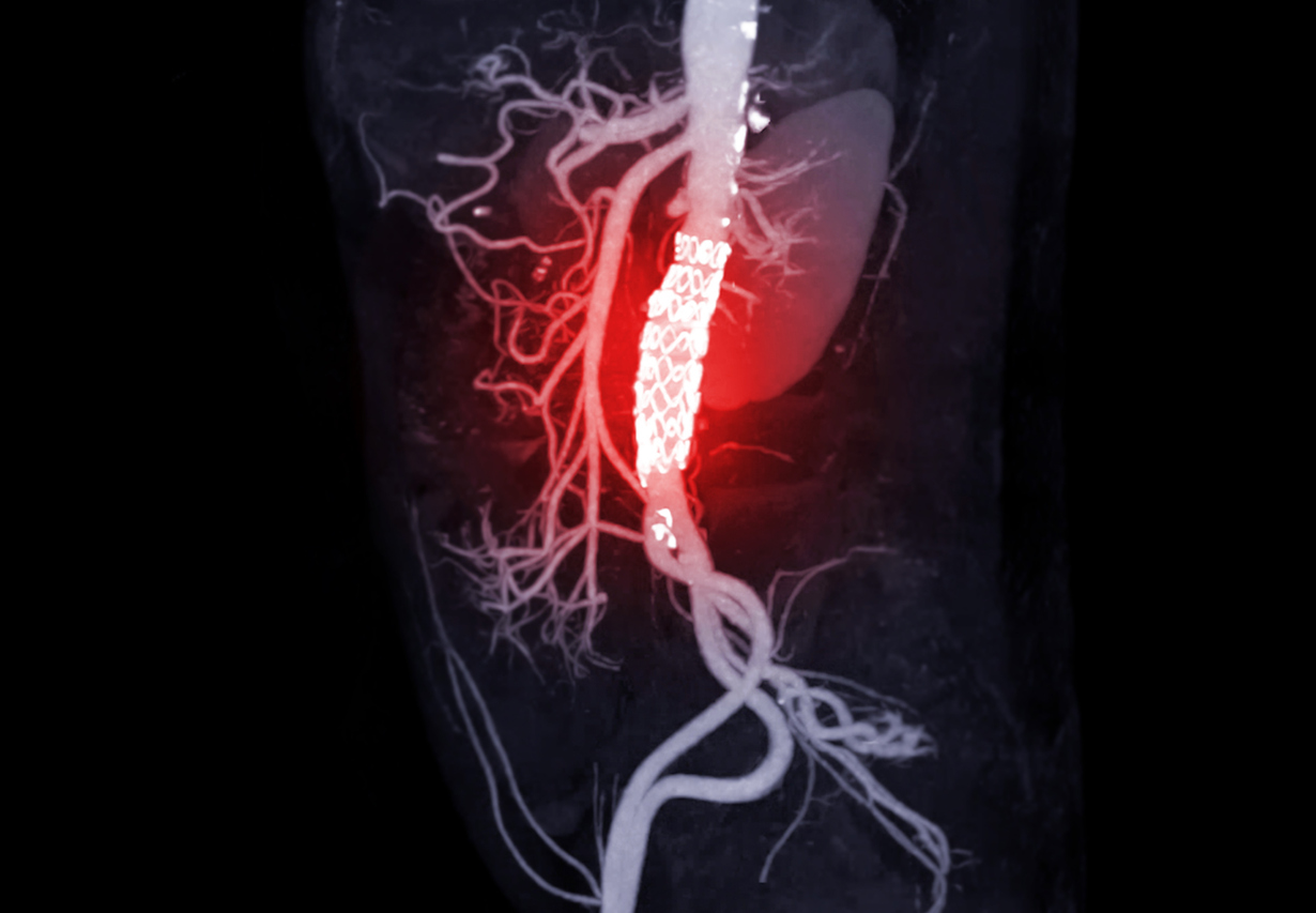 CTA of the abdominal aorta with stent-grafting in patient Abdominal aortic aneurysm.