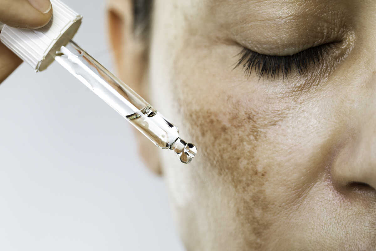 Unrecognizable female suffering from hyperpigmentation (melasma) is about to use face serum for skin brightening. 
She has dark spots on her face and  her eyes are closed.