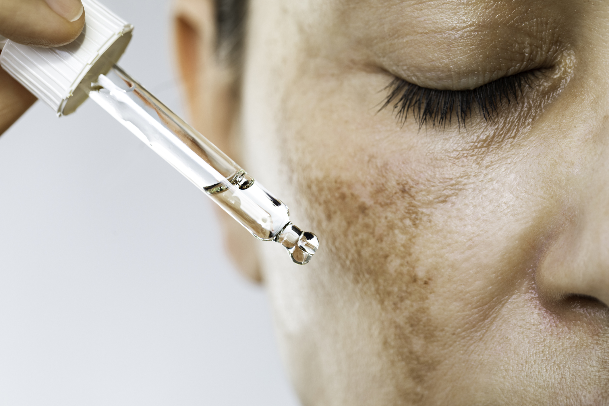 Unrecognizable female suffering from hyperpigmentation (melasma) is about to use face serum for skin brightening. 
She has dark spots on her face and  her eyes are closed.