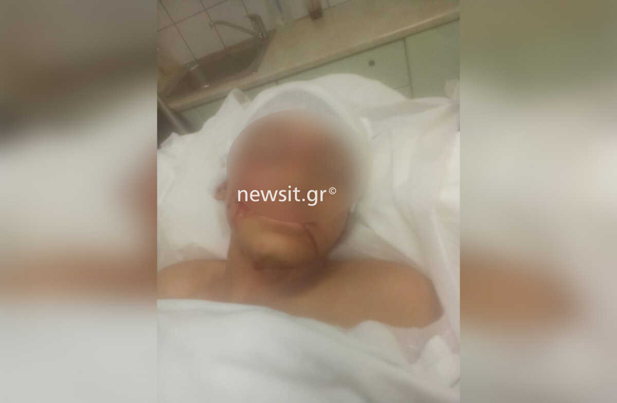 Επίθεση πιτ μπουλ σε 11χρονο στην Αρτέμιδα: «Πρόκειται για απόπειρα δολοφονίας του παιδιού!»