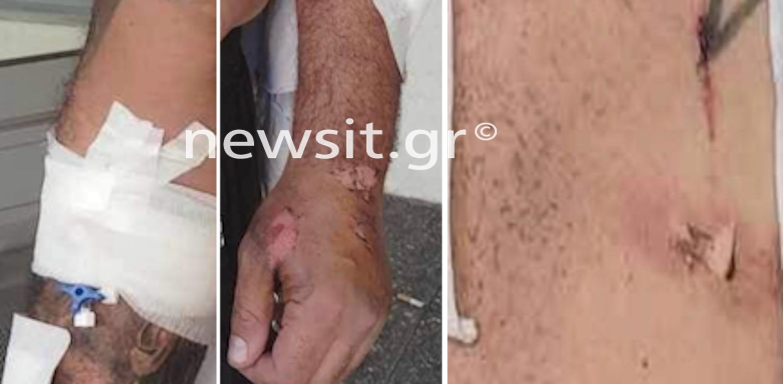 Θεσσαλονίκη: Φωτογραφίες ντοκουμέντα με τα τραύματα του 35χρονου που δέχθηκε επίθεση χούλιγκανς