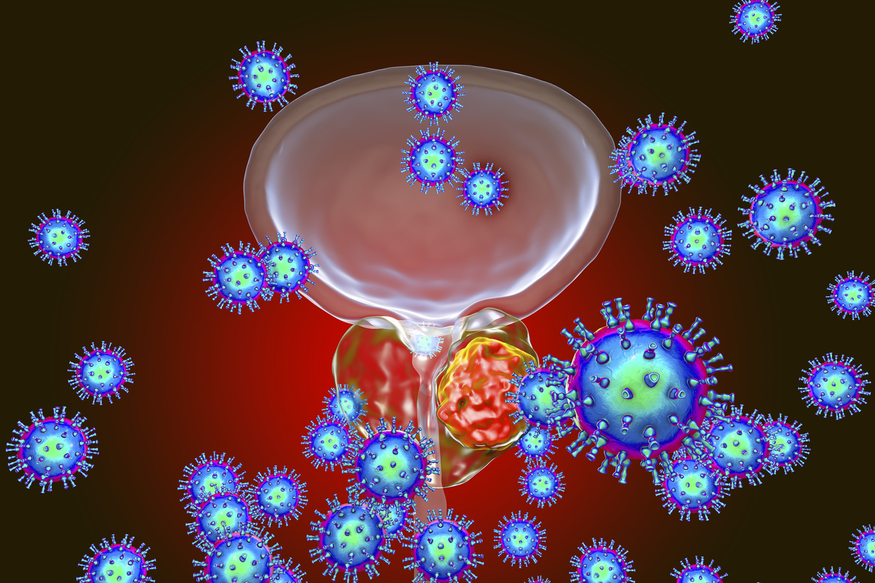 Conceptual image for viral ethiology of prostate cancer. 3D illustration showing viruses infecting prostate gland which develops cancerous tumor