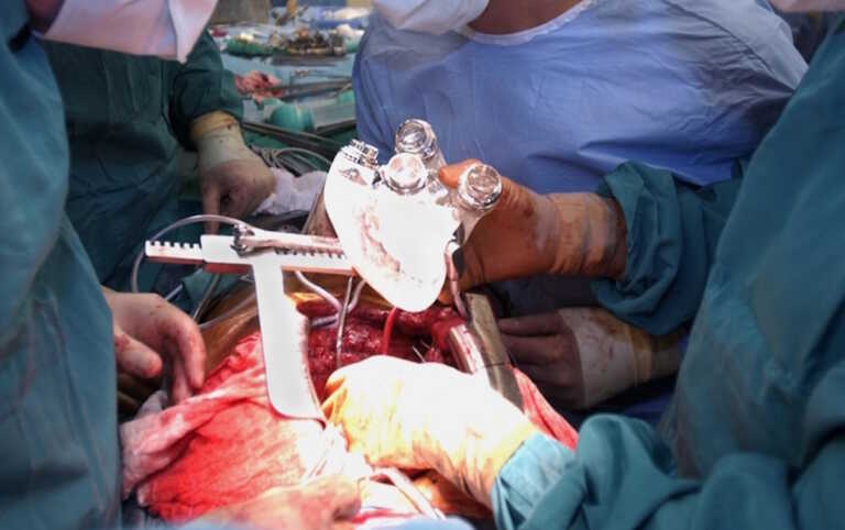 Πέθανε και ο δεύτερος ασθενής που του είχαν μεταμοσχεύσει καρδιά χοίρου – Έζησε 6 εβδομάδες