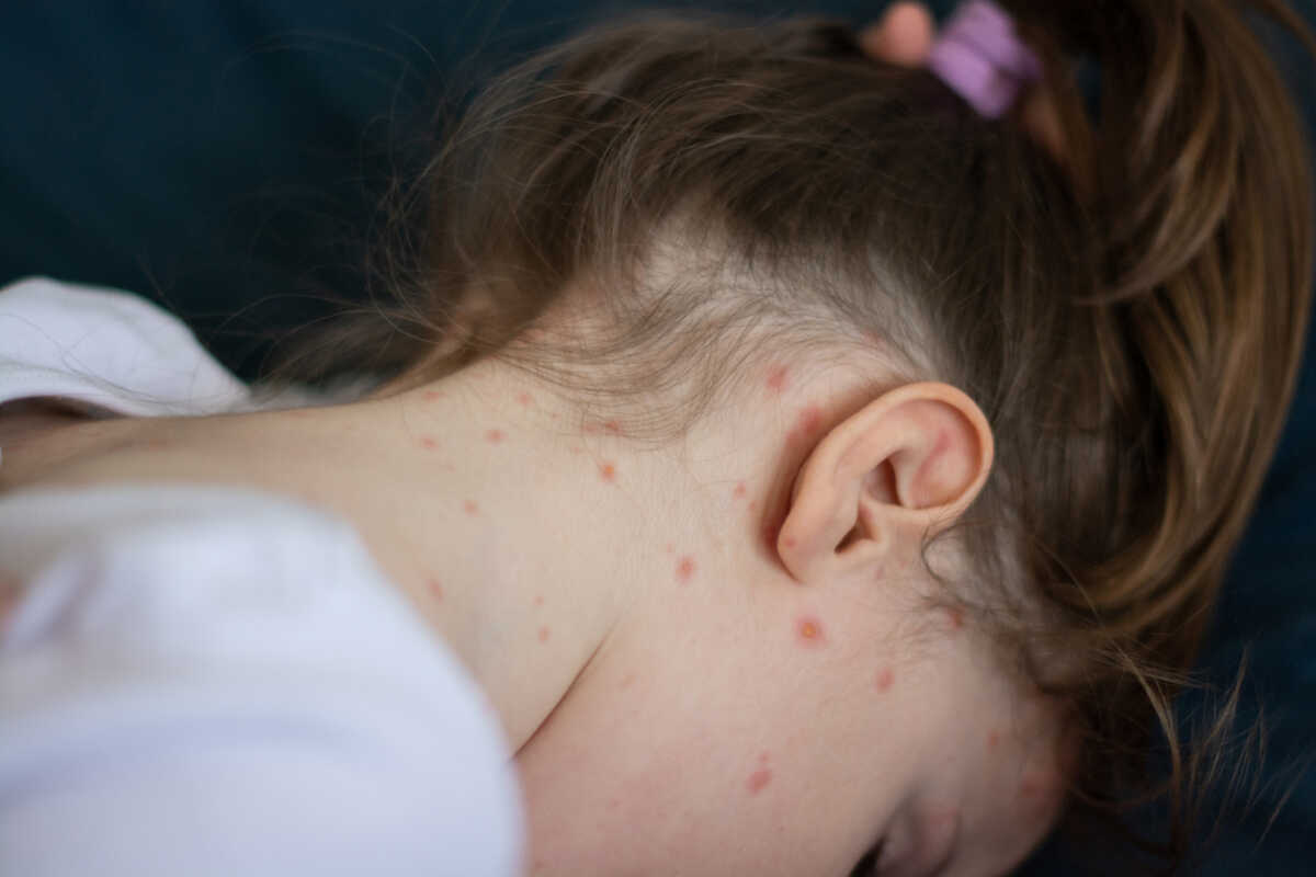 Close-up of a girl with chickenpox measles on her neck and face