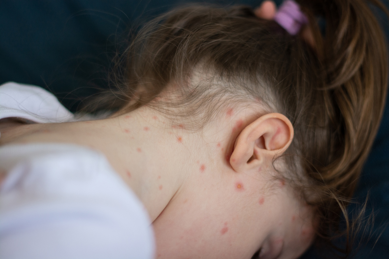 Επιδημία ιλαράς στη Ρουμανία – Ανεμβολίαστα παιδιά οι περισσότεροι ασθενείς