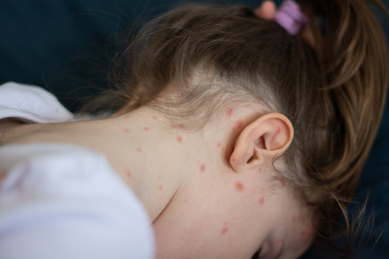 Close-up of a girl with chickenpox measles on her neck and face