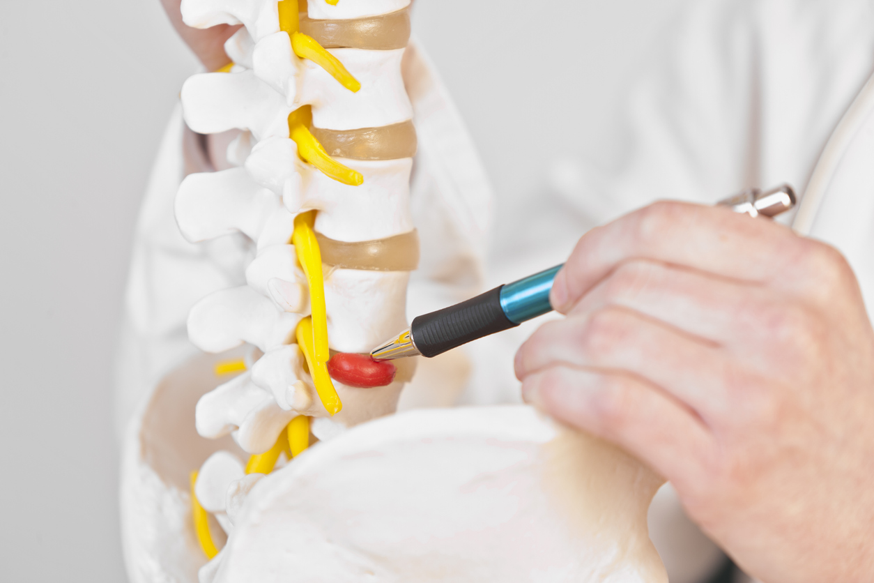 A medicine pointing at a prolapse of a lumbal spine discus. XXL size image.