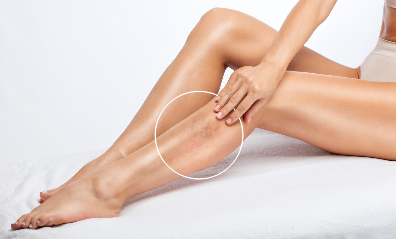 The woman shows the dilation of small blood vessels of the skin on the leg. Medical inspection and treatment of Telangiectasia. Phlebeurysm.