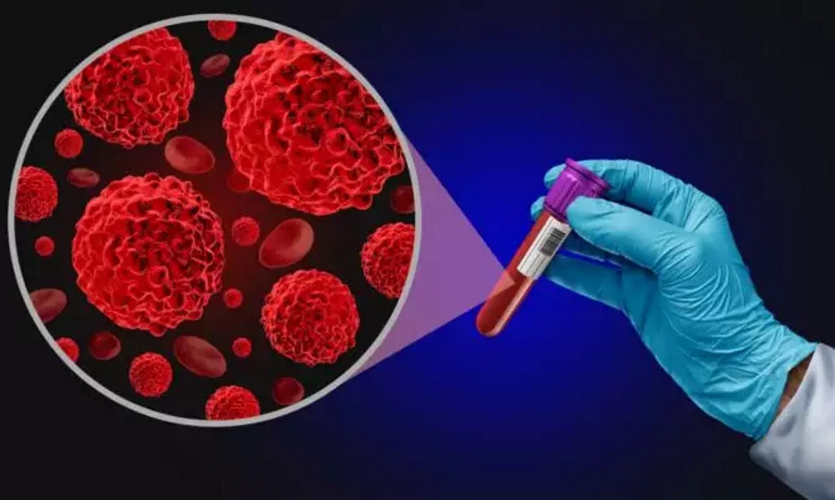 Εξέταση αίματος εντοπίζει τον καρκίνο του εντέρου ακόμα και χωρίς συμπτώματα