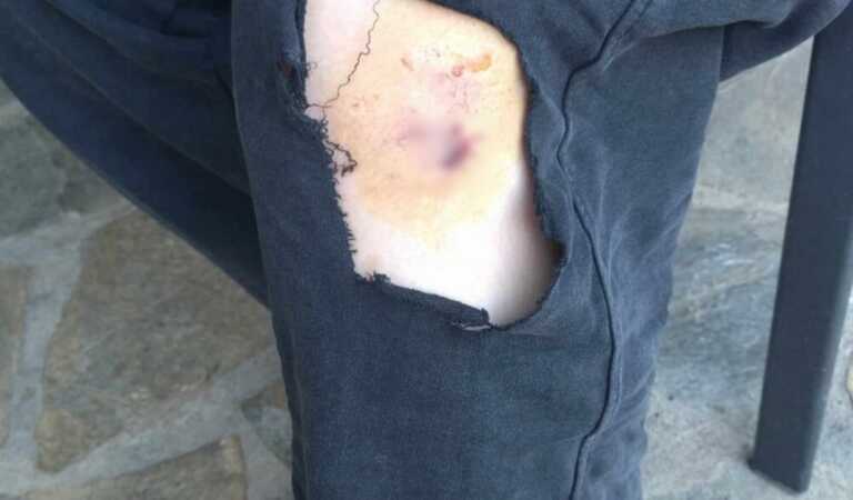 Φωτογραφία λίγο μετά την επίθεση που δέχτηκε 13χρονη μαθήτρια από αδέσποτο σκύλο στο Βελεστίνο