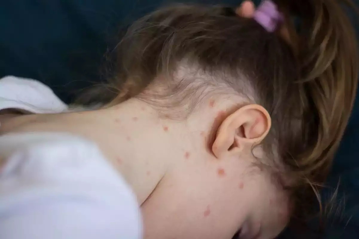 «Καμπανάκι» Παπαευαγγέλου για παράλληλη έξαρση κοκκύτη και ιλαράς λόγω εμβολιαστικών κενών