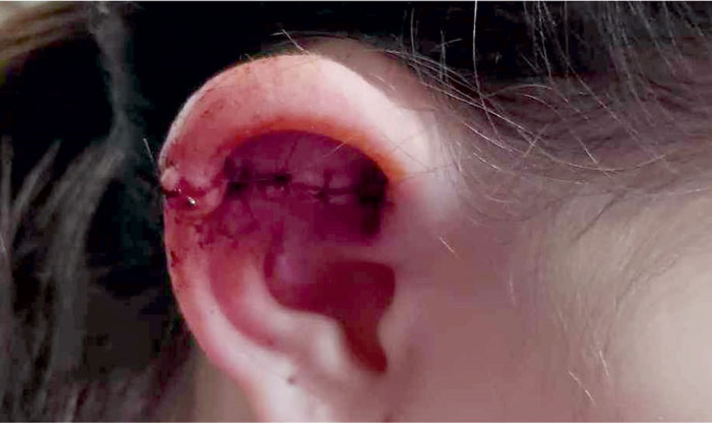 Αμφιλοχία: 9χρονη έκοψε το αυτί της σε κλειστή παιδική χαρά