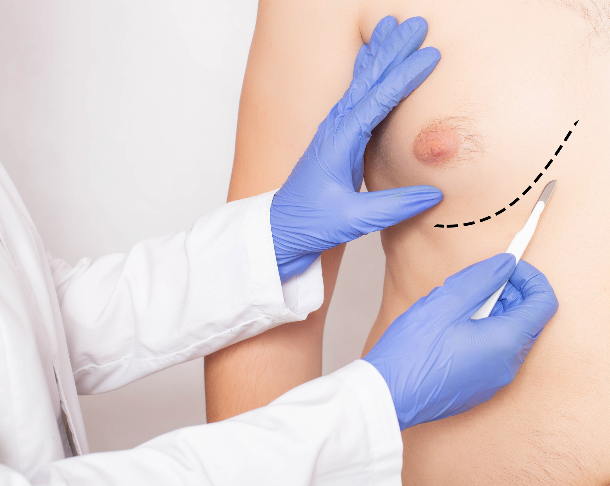 Doctor plastic surgeon with scalpel near male patient's chest. Male Breast and Nipple Reduction Concept, background