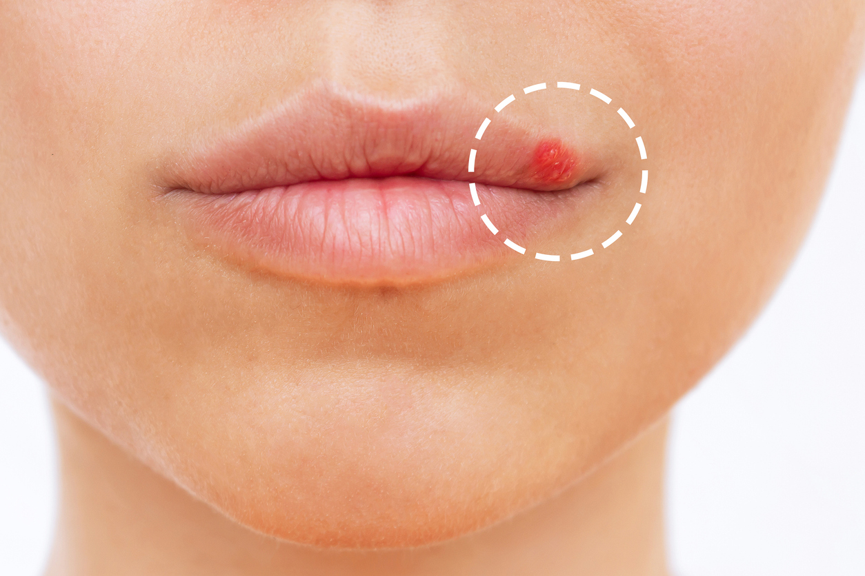Herpes on the lip. Blisters on the mouth of a young woman isolated on a white background. Itching and redness on the girl's face. Close up