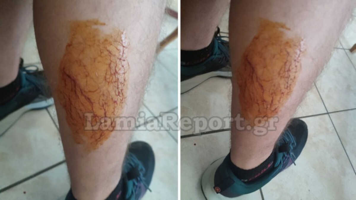 Λαμία: Στο νοσοκομείο 15χρονος μετά από επίθεση από σκύλο