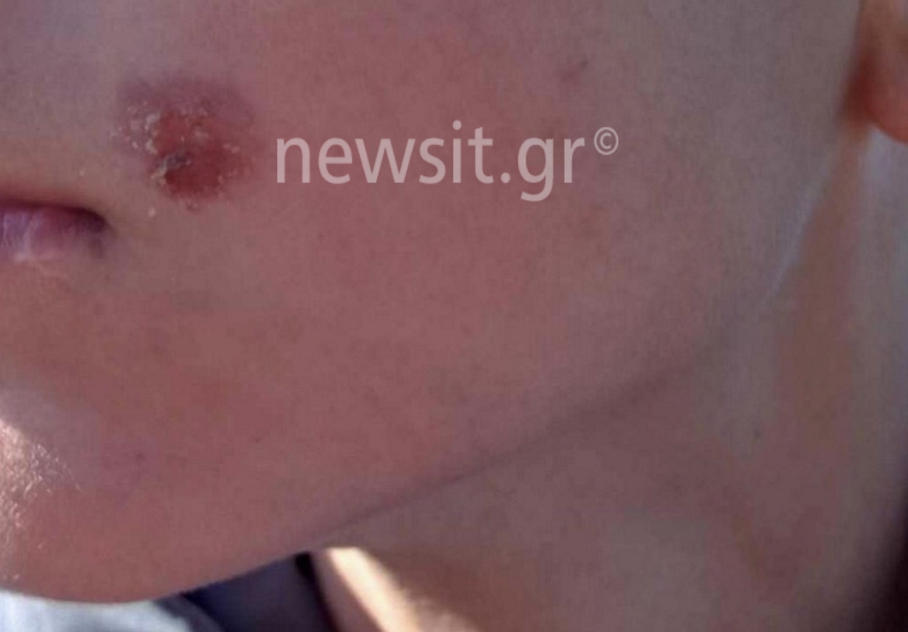 Πέλλα: 15χρονος έσβησε τσιγάρο στο μάγουλο 14χρονου μαθητή, εικόνα ντοκουμέντο
