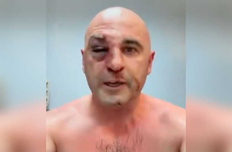 Απήγαγαν και «σάπισαν» στο ξύλο τον ηγέτη της αντιπολίτευσης στη Γεωργία - Εικόνες σοκ