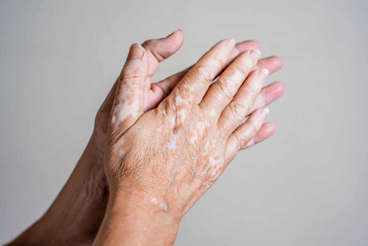 A closeup shot of hands of a senior woman with vitiligo illness on a gray background