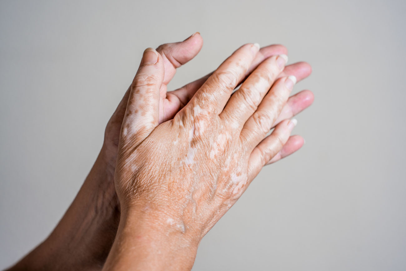 A closeup shot of hands of a senior woman with vitiligo illness on a gray background