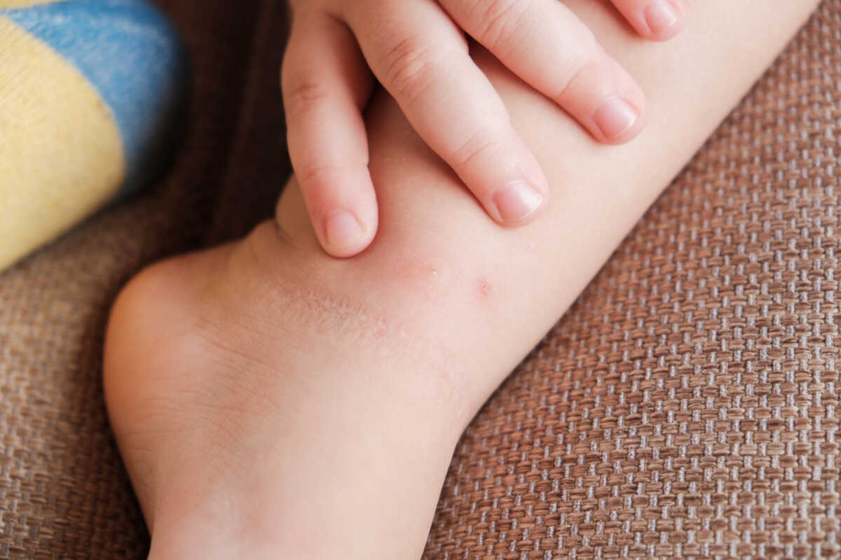 Toddler touches her leg after being bitten by mosquito or bedbug, suffering from allergic reaction and swelling, experiencing pain, sits on bed at home. Skin reaction to blood-sucking insects. Allergy