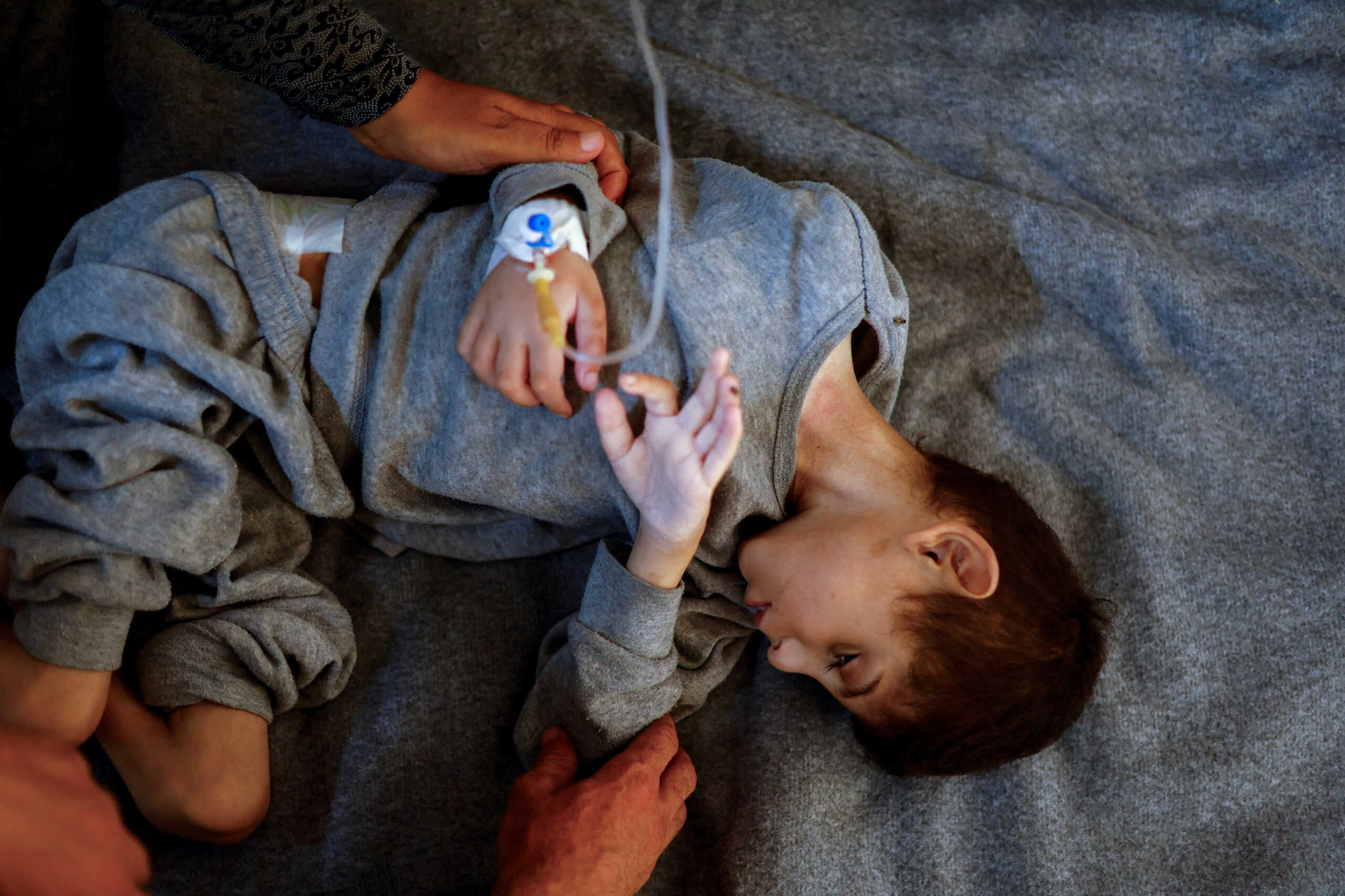 Younis Joma, a malnourished Palestinian boy, receives treatment at at Nasser hospital in Khan Younis, in the southern Gaza Strip, July 8, 2024. REUTERS