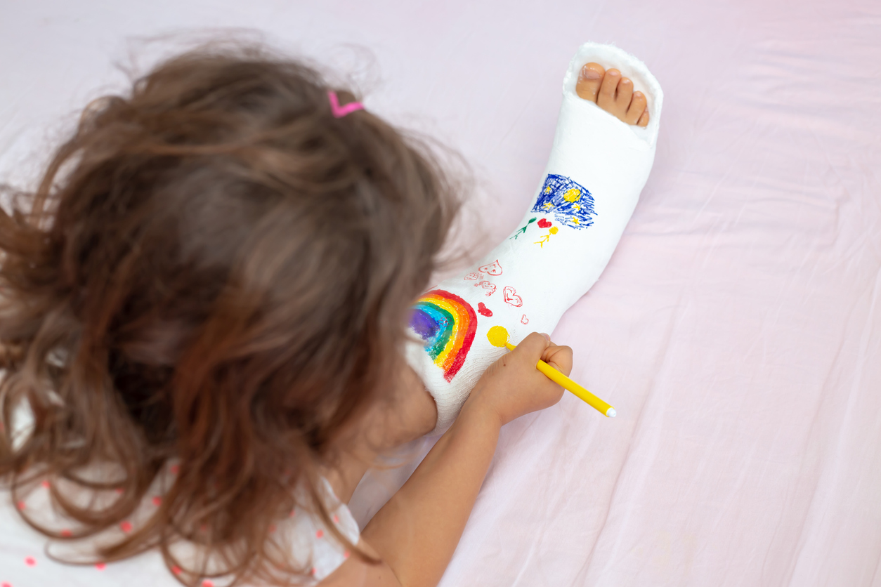 The child's leg is broken. A unrecognizable little girl of 10 years old broke a leg bone as a result of an accident. A child draws on a plaster cast to support morale