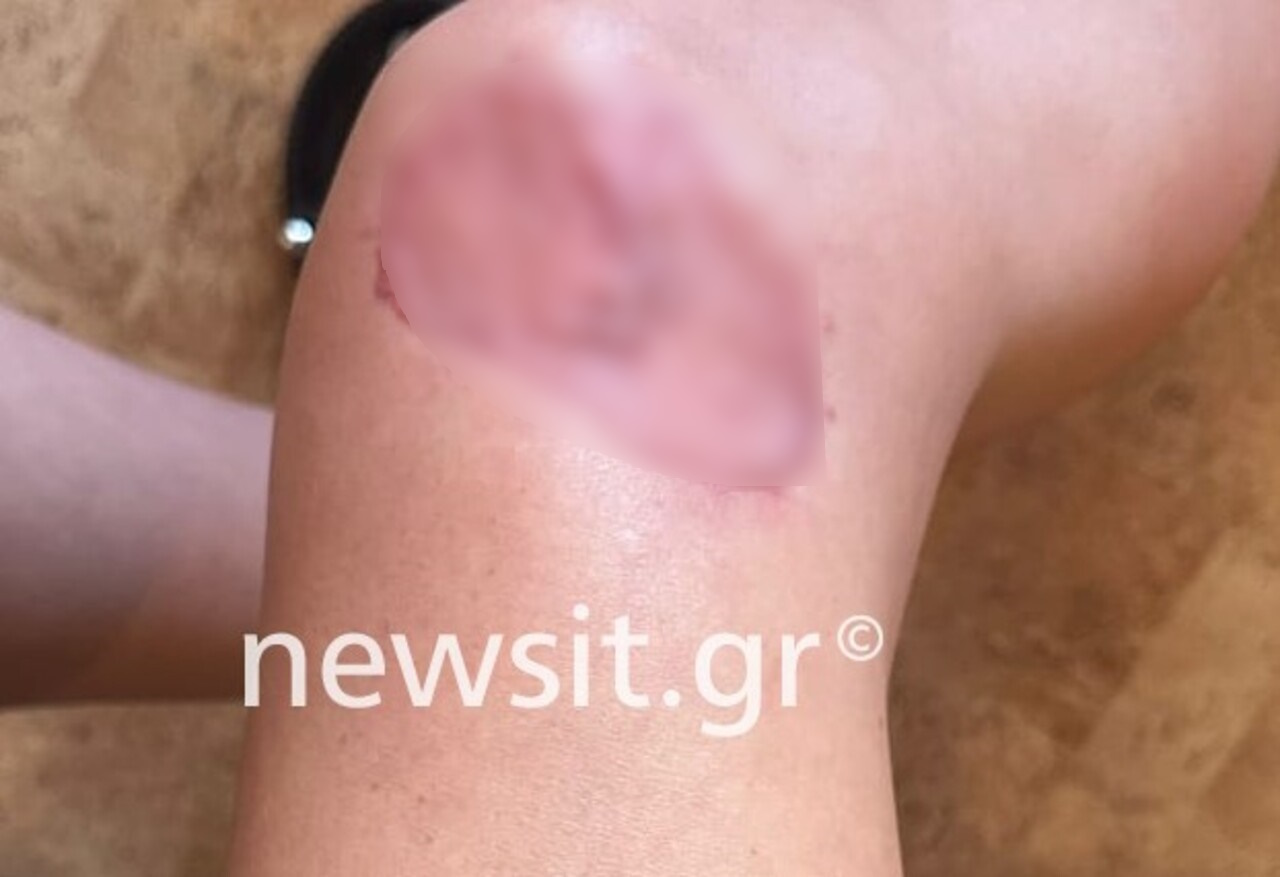 Γολγοθάς για γνωστή influencer: Παραλίγο να της ακρωτηριάσουν το πόδι μετά από επέμβαση στήθους – Φωτογραφίες ντοκουμέντα