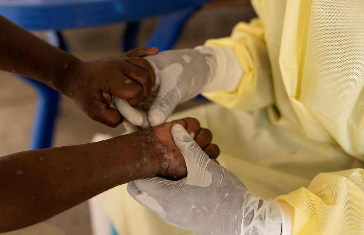 FILE PHOTO: Christian Musema, a laboratory nurse, takes a sample from a child declared a suspected case of Mpox  at the treatment centre in Munigi, following Mpox cases in Nyiragongo territory near Goma, North Kivu province, Democratic Republic of the Congo July 19, 2024. REUTERS