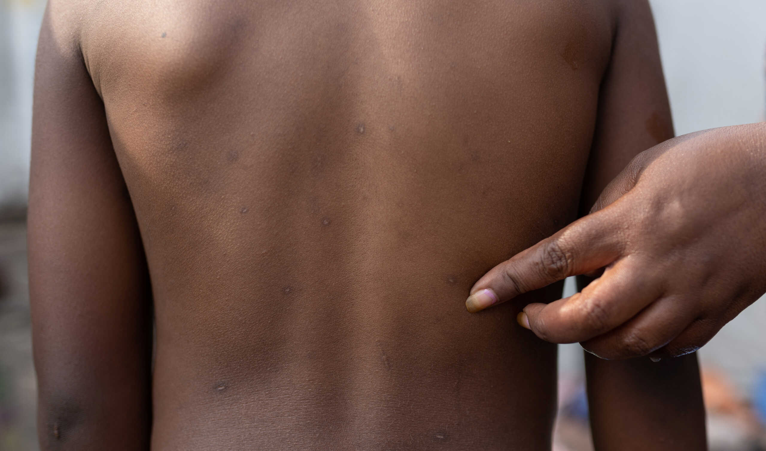 Zawadi Bwira Bakulu, 35, shows the rash marks on her son Christevie Lukeka who recovered from Mpox - an infectious disease caused by the monkeypox virus that spark-off a painful rash, enlarged lymph nodes and fever; outside their shelter at the Muja displaced persons camp, following Mpox cases in Nyiragongo territory near Goma, North Kivu province, Democratic Republic of the Congo July 18, 2024. REUTERS