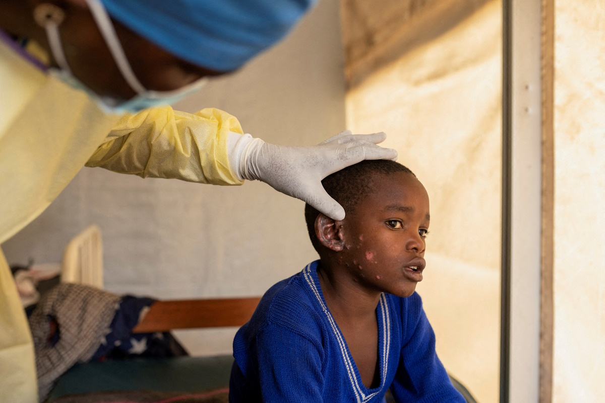 FILE PHOTO: Dr. Tresor Wakilongo, verifies the evolution of skin lesions on the ear of Innocent, suffering from Mpox - an infectious disease caused by the monkeypox virus that sparks off a painful rash, enlarged lymph nodes and fever; at the treatment centre in Munigi, following Mpox cases in Nyiragongo territory near Goma, North Kivu province, Democratic Republic of Congo July 19, 2024. REUTERS