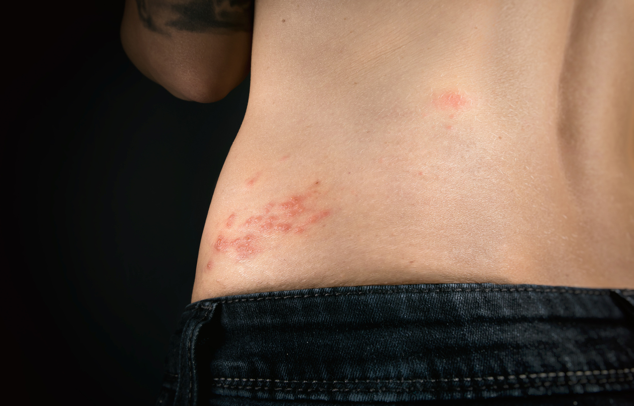 The varicella-zoster virus has formed a red rash with fluid-filled blisters on the lower back (shingles belt)