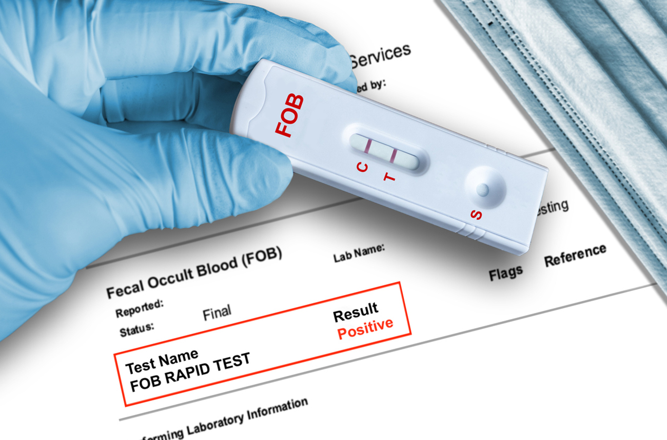 Fecal Occult Blood (FOB) positive test result by using rapid testing device held by hand in medical glove with medical face mask in background. FOB test detects gastrointestinal problems such as colon cancer, ulcers, polyps, colitis, diverticulitis and fissures.