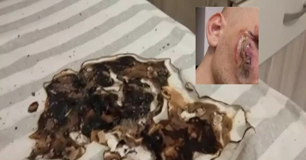 “The battery threw liquid on my face, it was like they threw acid on me”, says the injured person from the mobile phone explosion