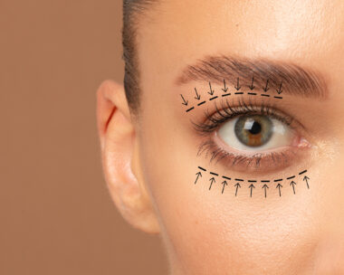 Blepharoplasty concept. Closeup view of lady eye with arrows point in direction of planned oculoplastic surgery to tighten and lift the skin around the eyes