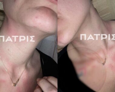 Τα σημάδια στον λαιμό της 26χρονης από παλαιότερο ξυλοδαρμό της