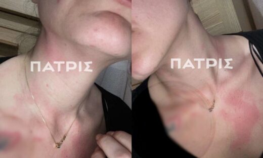 Τα σημάδια στον λαιμό της 26χρονης από παλαιότερο ξυλοδαρμό της