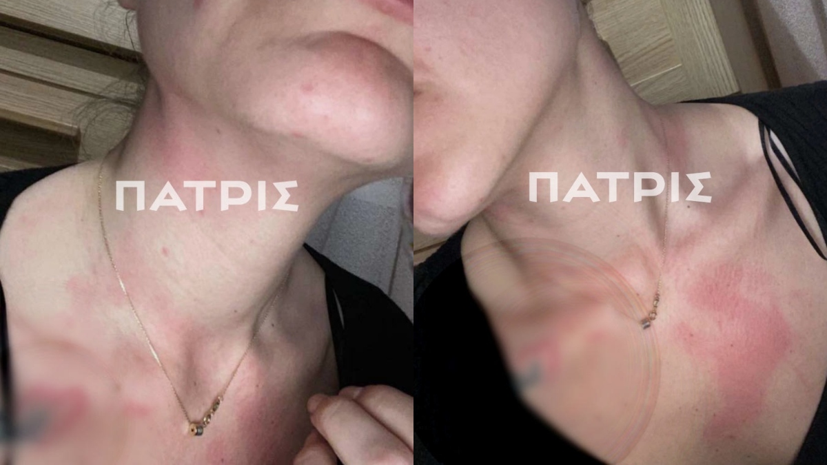 Τα σημάδια στον λαιμό της 26χρονης από παλαιότερο ξυλοδαρμό της