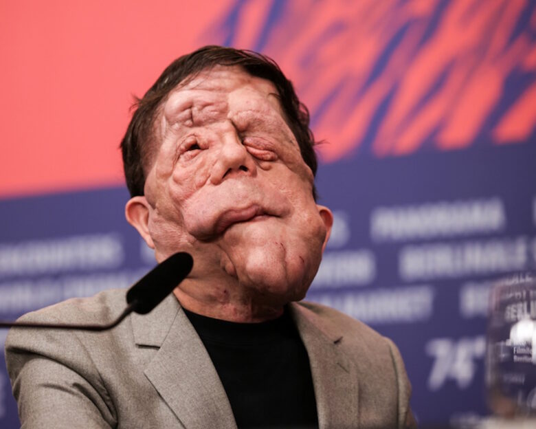 Νέα μεταφορά στη μεγάλη οθόνη του «The Elephant Man» με πρωταγωνιστή τον Άνταμ Πίρσον