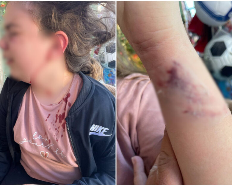 Πέλλα: Άγρια επίθεση από αδέσποτο σκυλί σε 10χρονη – «Της όρμησέ και την έριξε κάτω», λέει η μητέρα της