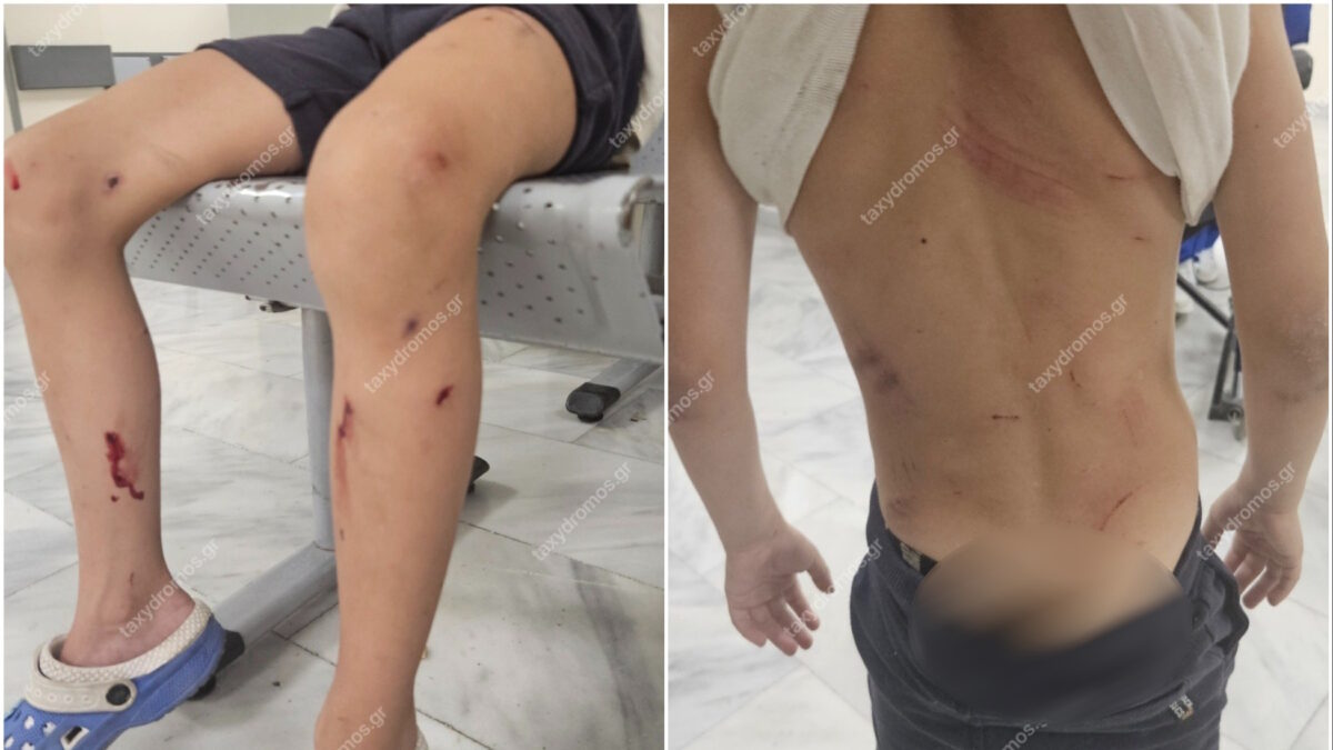Επίθεση σκυλιών σε 7χρονο στον Βόλο