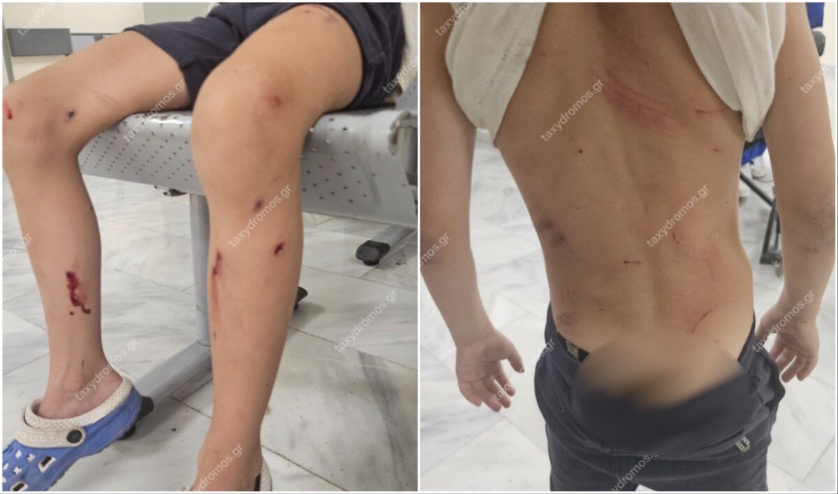 Επίθεση σκυλιών σε 7χρονο στον Βόλο