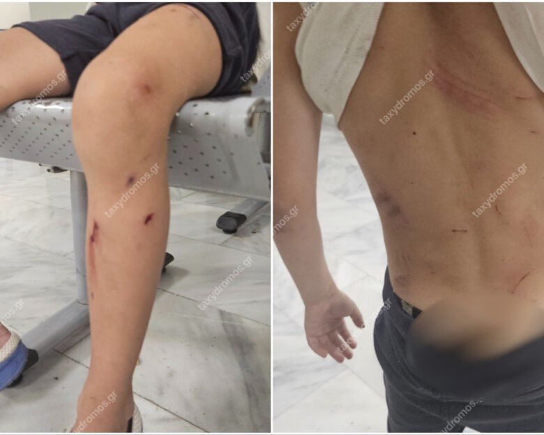 Βόλος: Στο νοσοκομείο 7χρονος μετά από επίθεση σκυλιών – «Παραλίγο να το κατασπαράξουν» λέει η μητέρα του