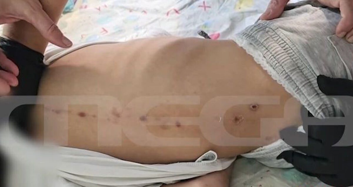 Τα σημάδια στο κορμάκι του 7χρονου ΑμεΑ στην Πάτρα