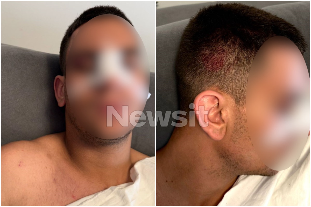 Με τραύματα στο πρόσωπο νοσηλεύεται ο νεαρός που έπεσε θύμα ξυλοδαμρού στη Χαλκίδα