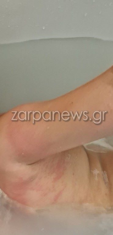 Τσίμπημα από θαλάσσια ανεμώνη