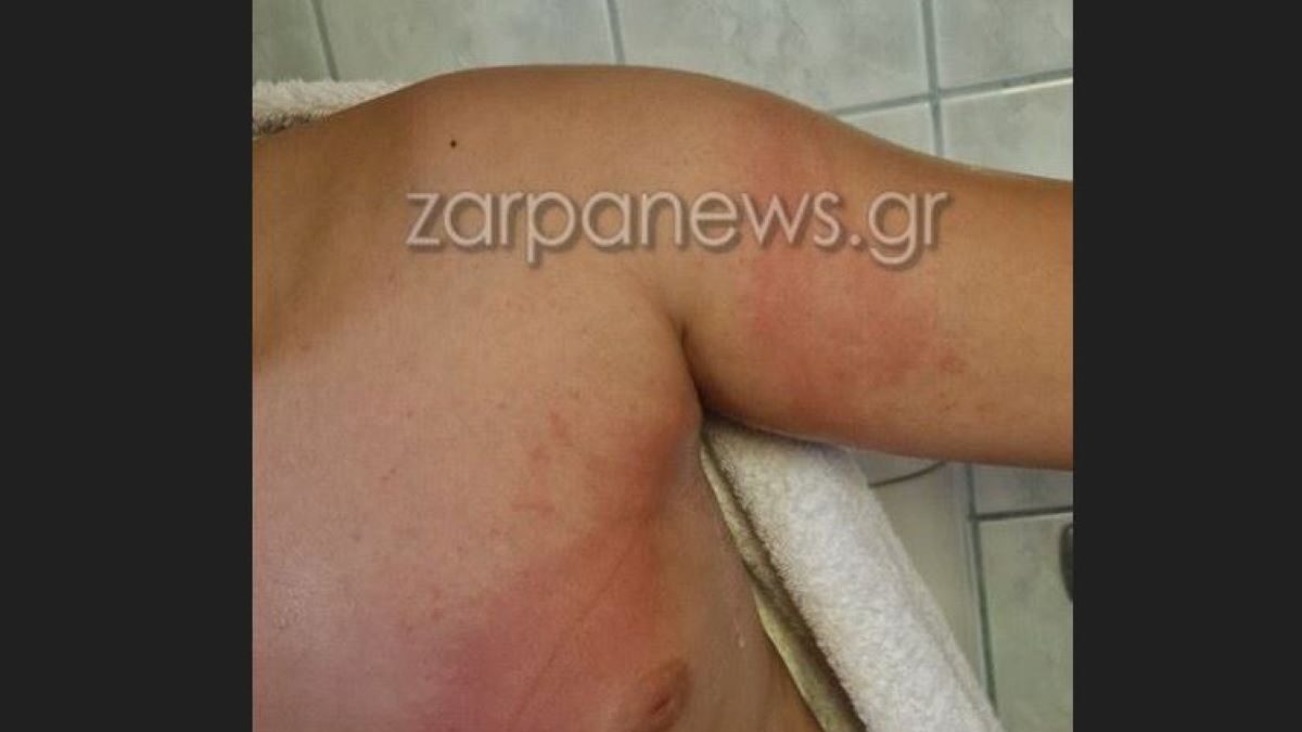Τσίμπημα από θαλάσσια ανεμώνη σε 11χρονο