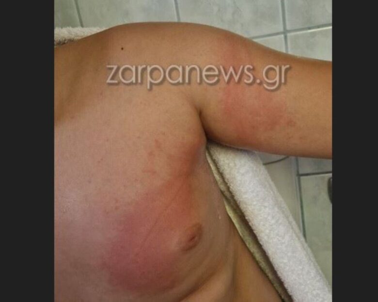 Χανιά: 11χρονος τσιμπήθηκε από θαλάσσια ανεμώνη και γέμισε με εξανθήματα
